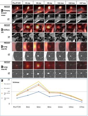 Oncolytic virotherapy for metastatic breast cancer – a case report